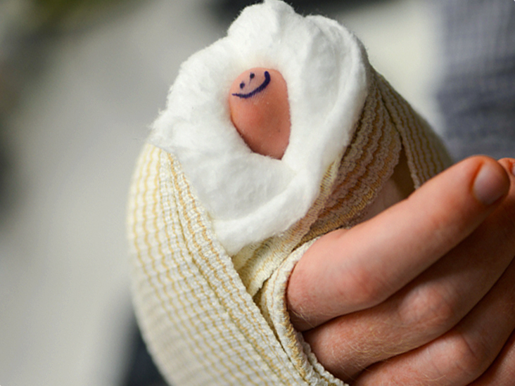 Broken Thumb: Symptoms, Treatment, Recovery, Complications, and More