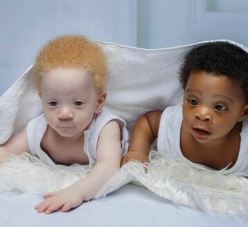 Bliźnięta, które urodziły się z różnym kolorem skóry