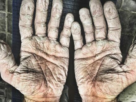 Dłonie wioślarza Alexa Gregory po wielogodzinnym wiosłowaniu w mokrych rękawicach chroniących przed powstaniem pęcherzy