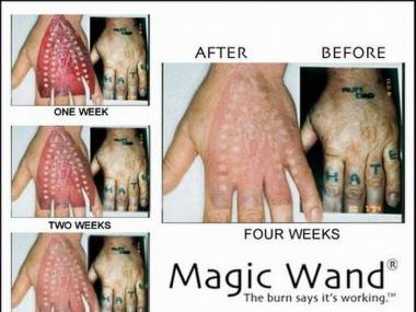 Magiczna różdżka do usuwania tatuaży