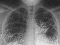 Zdjęcie rentgenowskie człowieka, który popełnił samobójstwo wstrzykując sobie rtęc